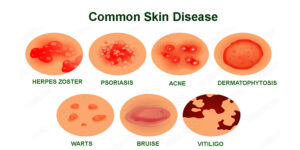 Ayurvedic Treatment for Skin Diseases
